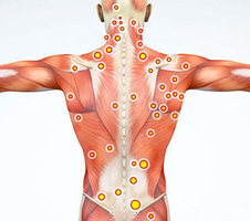 Trigger Point Injections