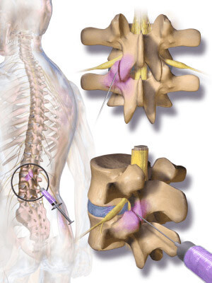 Pain Relief Injections