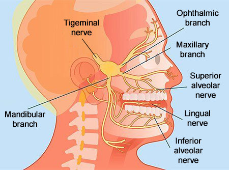 Trigeminal Neuralgia